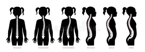 Tipi Di Deformità Spinale Malattie Della Colonna Vertebrale Scoliosi E