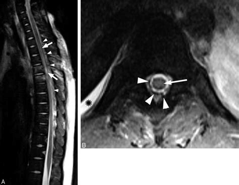 Thoracic Spine Mr Imaging A Sagittal T Weighted Mr Image Of The