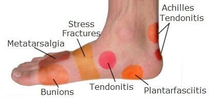 Foot Pain Causes