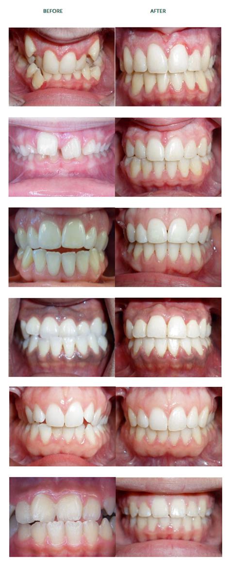 Spring Retainer Before And After