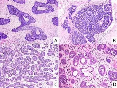 Four Types Of Esophageal Basaloid Squamous Cell Carcinoma Ebscc A