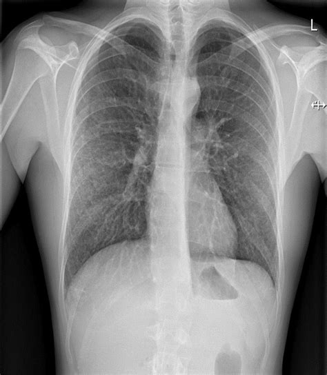 Pulmonary Haemorrhage In Weils Disease Bmj Case Reports