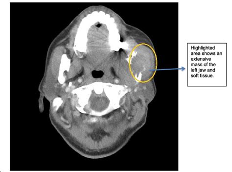 Showing A Contrast Enhanced Axial Ct Of The Neck Highlighted Area Download Scientific Diagram