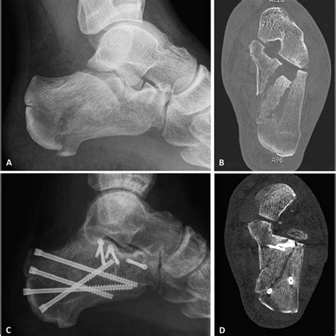 (PDF) Similar Anatomical Reduction and Lower Complication Rates With ...