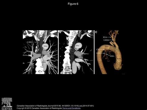 The Normal Anatomy And Variations Of The Bronchial Arteries Evaluation