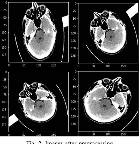 Figure 2 From Intracranial Hemorrhage Detection Using CNN LSTM Fusion