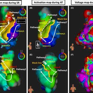 Activation Map During Sr And At And Voltage Map During Sr The Left