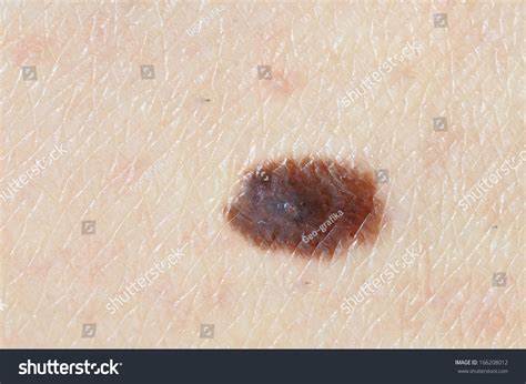 Close-up Brown Birthmark Nevus On Caucasian Stock Photo 166208012 ...