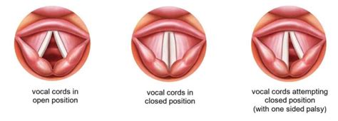 Larynx - CAUSES OF VOCAL CORD PALSY - Dr. Meenesh Juvekar - ENT Specialist