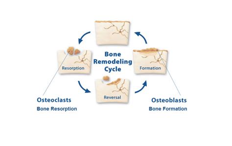 Factors that influence bone regeneration - Ibi