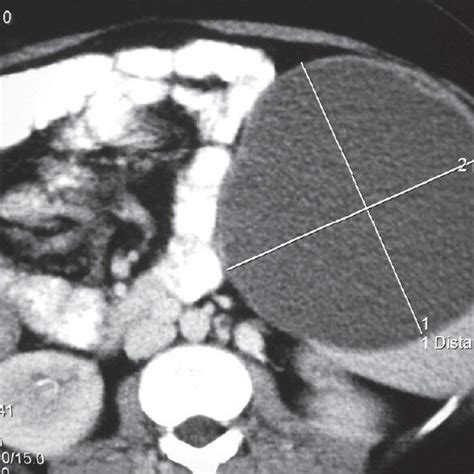 A Contrast Enhanced Computed Tomography Showing Pelvic Hydatid Cyst Download Scientific