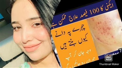 How To Remove Pimple Overnight Acne Treatment Pimples Khatam Karne