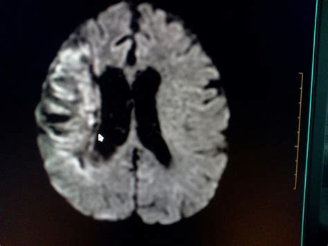 Radiodiagnóstico RMN Cerebral ECV Isquémico Mapa ADC