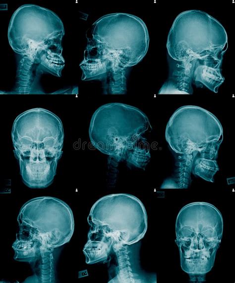 Lateral De La Imagen De La Radiografía Y Visión Frontal Imagen de