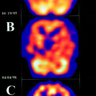 (PDF) Brain SPECT imaging in Huntington's disease before and after therapy with olanzapine ...