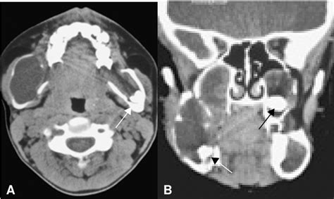 PDF Odontogenic Keratocysts In Nevoid Basal Cell Syndrome Gorlin