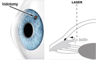 What Is A Laser Iridotomy? Success Rate, Side Effects, Complications