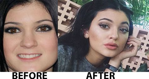 Kylie Jenner Plastic Surgery Before And After Nose Job Lip Injections