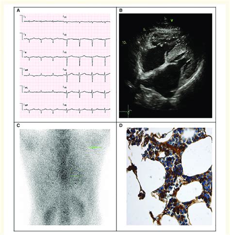 Main Diagnostic Tests Used For Diagnosing Cardiac Amyloidosis