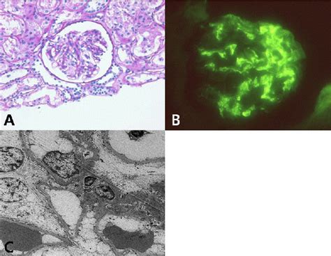 A Pas Stain Reveals A Glomerulus Showing Segmental Expansion Of The