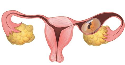 Embarazo Ectópico ¿qué Es Y Qué Consecuencias Puede Llegar A Tener