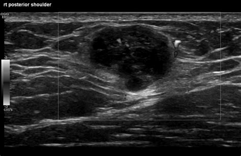 Imaging Features Of Myxoid Soft Tissue Tumours Clinical Radiology