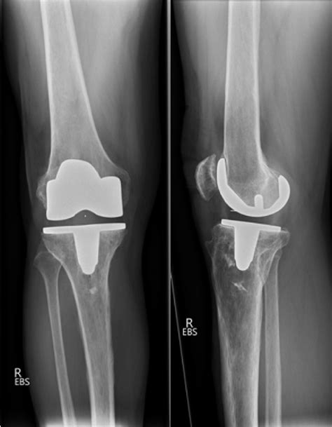 Figure 1 From Diagnostic Algorithm In Patients With Flexion Instability