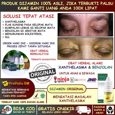 Obat Xanthelasma Penghilang Flak Kuning Di Kelopak Mata Gumpalam Lemak