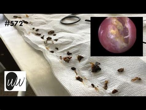 572 - Bulging Eardrum Revealed Post Difficult Ear Wax Removal - YouTube | Impacted ear wax, Ear ...