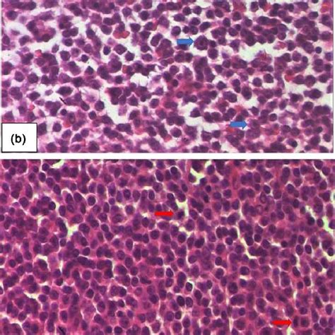 Right Axillary Lymph Node Biopsy Showed The Lymph Nodes Involved By