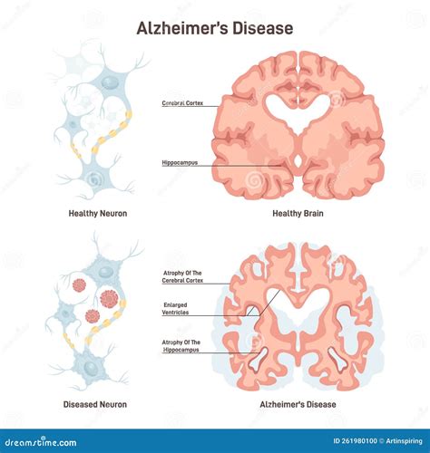 Alzheimer S Disease Human Brain Cross Section Healthy And Diseased