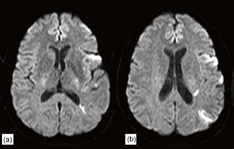 Axial Brain Mri In Dwi Sequence Panels A And B Show Diffusion