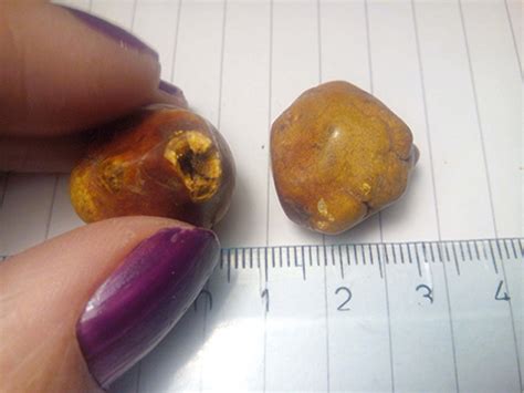 9mm Gallstone Size Chart