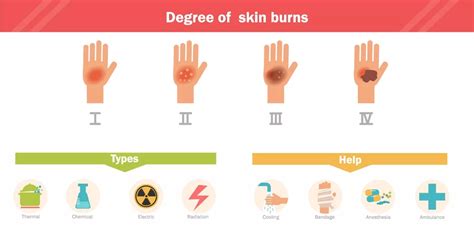 Burn Types Chart