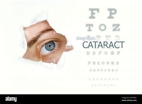 Cataract Eye Test Chart