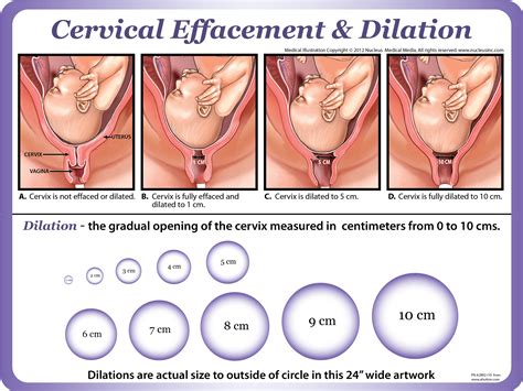 Dilation Effacement Chart
