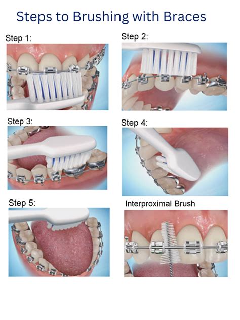 How To Care For Braces