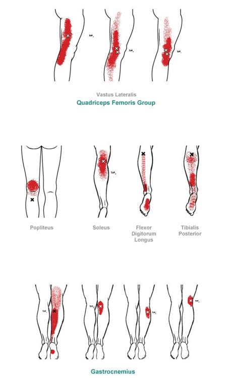 Leg Trigger Points Chart