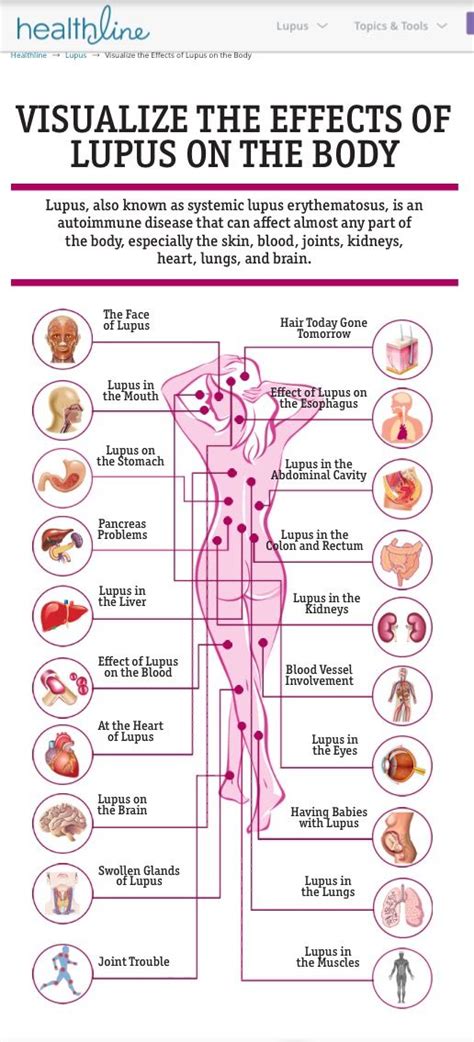 Lupus Pain Points Chart