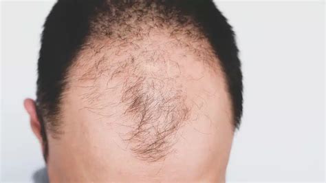 Short Haircuts For Male Pattern Baldness