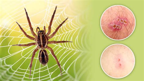 Spider Bite Identification Chart Pictures