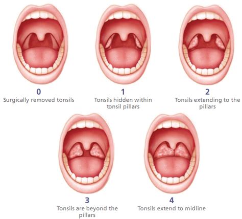 Tonsils Size Chart