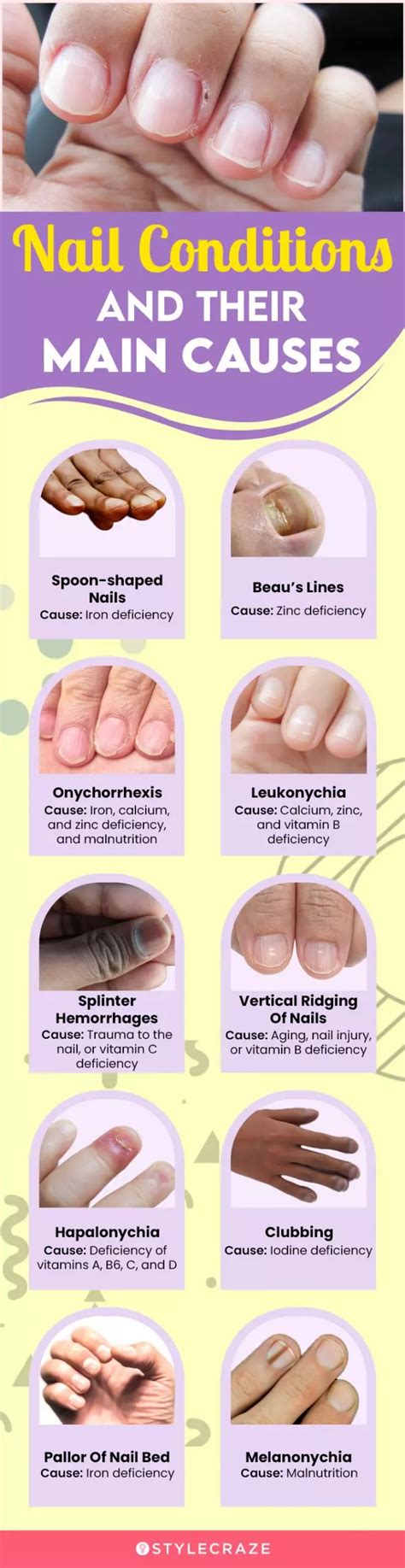 Vitamin Iron Deficiency Nail Health Chart