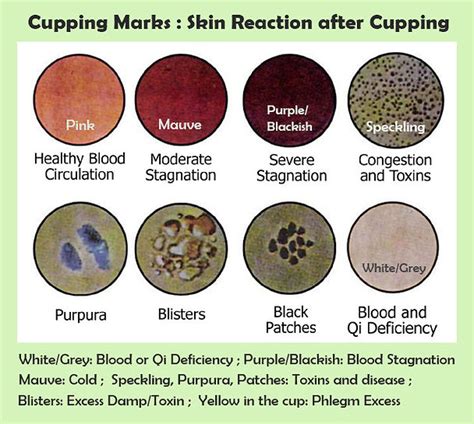 Cupping Bruises Chart