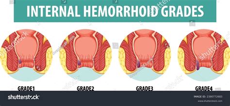External Hemorrhoid Size Chart