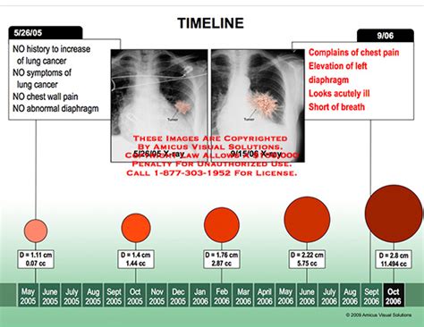 Lung Tumor Size Chart